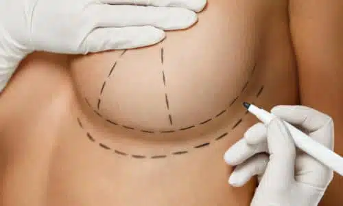 breast augmentation by plastci and cosmetic surgery associates- Dr zain