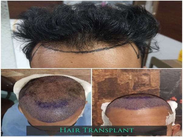 Hair transplant in Lahore