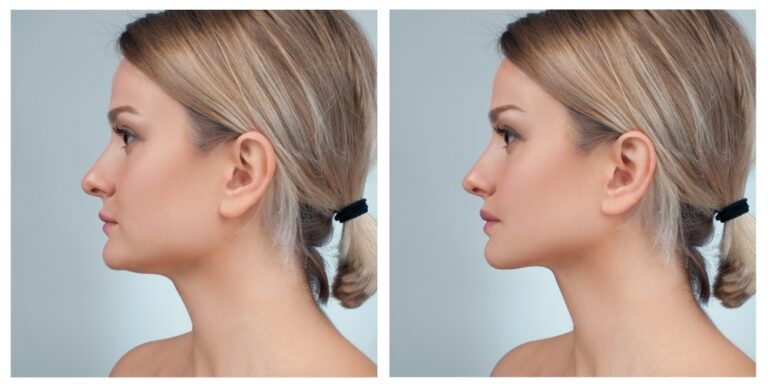 Rhinoplasty Price in Pakistan
