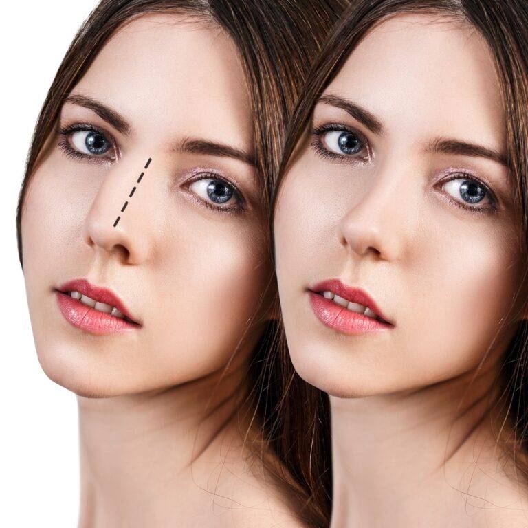 Reconstructive rhinoplasty surgery in Lahore