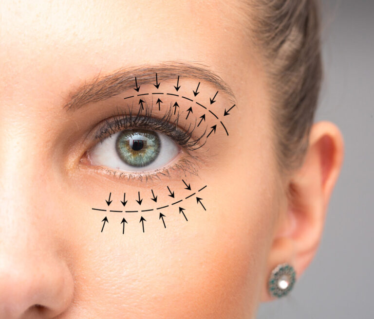 Eyelid Surgery/Blepharoplasty Price in Pakistan