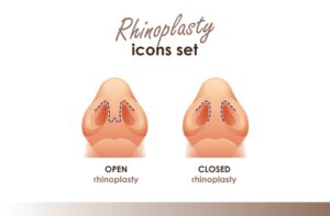 open and close rhinoplasty