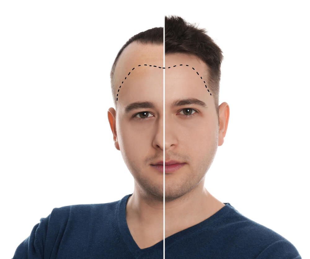 Best Hair Transplant in Pakistan- FUE Treatment - Low cost hair transplant