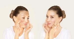 Skin-Whitening Chemical Peel