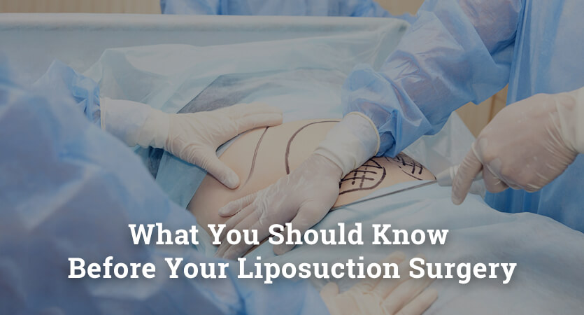What You Should Know Before Your Liposuction Surgery