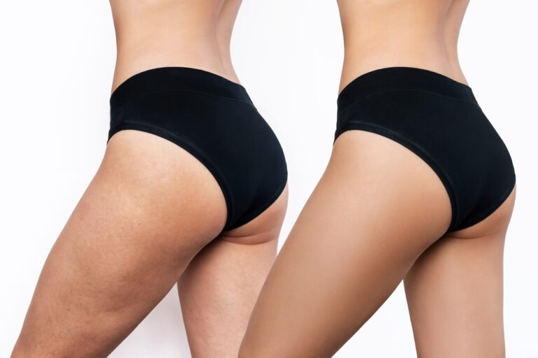 Thigh Lift Surgery Price in Pakistan