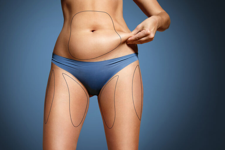 Liposuction Surgery Price in Pakistan