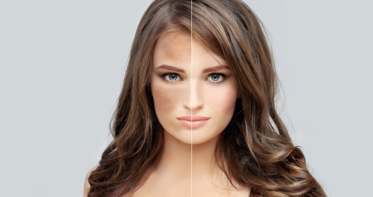 Skin Whitening Treatment