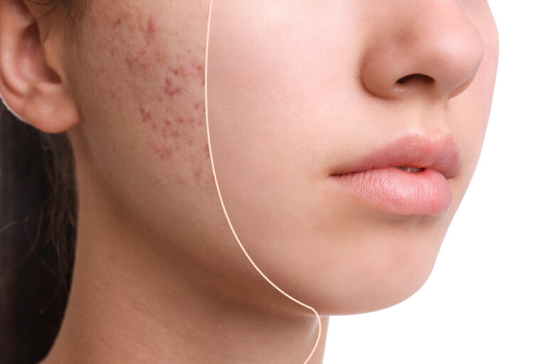 Acne Scar Treatment