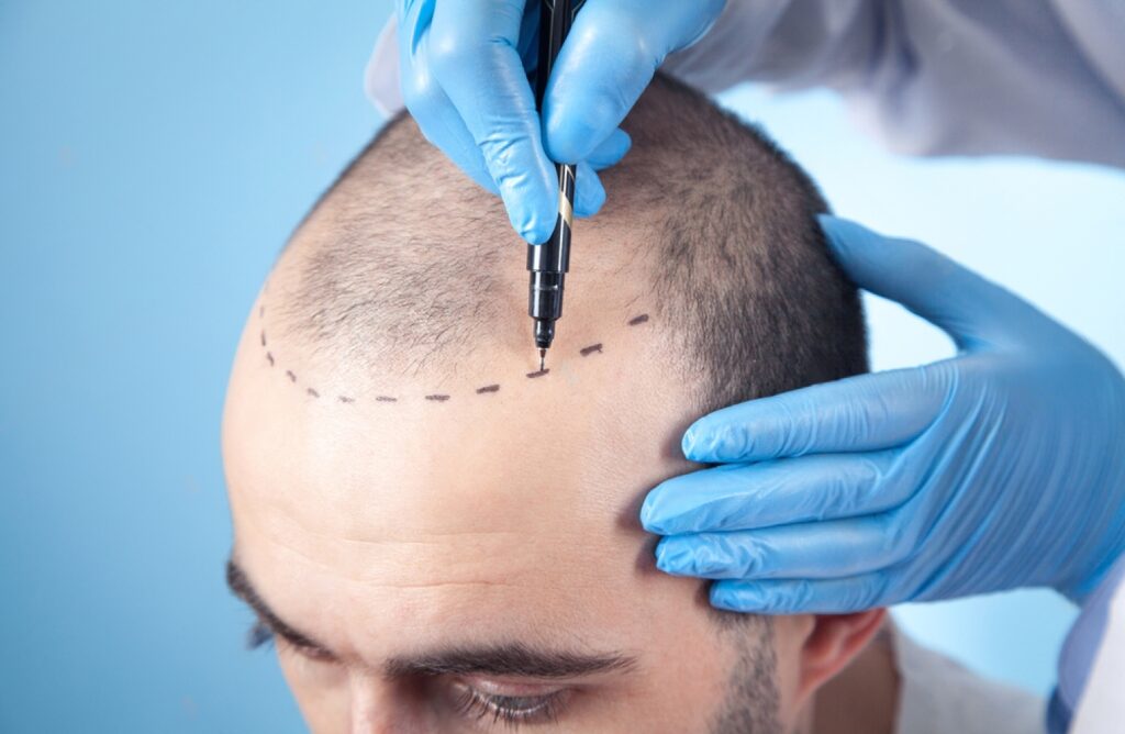 Is A Hair Transplant Successful For Anyone
