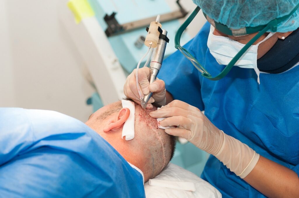 Explain The Process Of A Hair Transplant