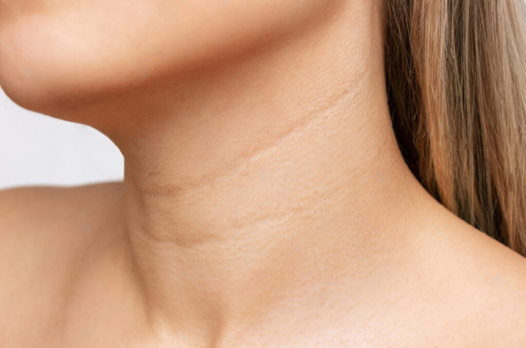 Neck Lift Surgeon