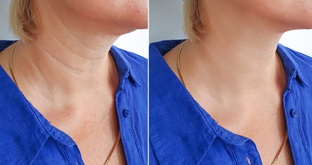 Problems With Neck Lifts