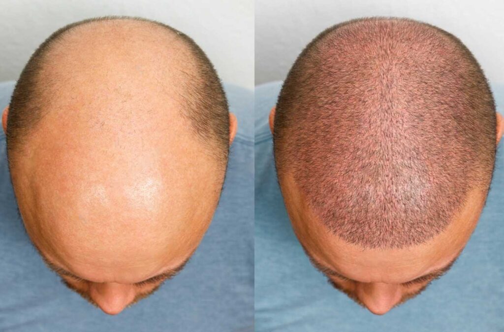 Advantages of Hair Transplants