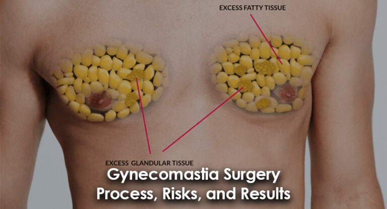 Gynecomastia Surger