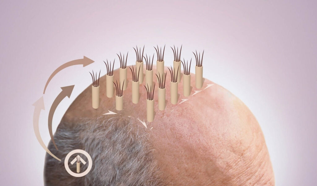 Process of Hair Transplantation