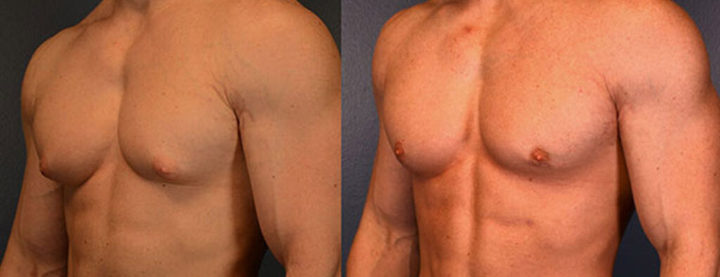 Psychological Changes After Gynecomastia Surgery
