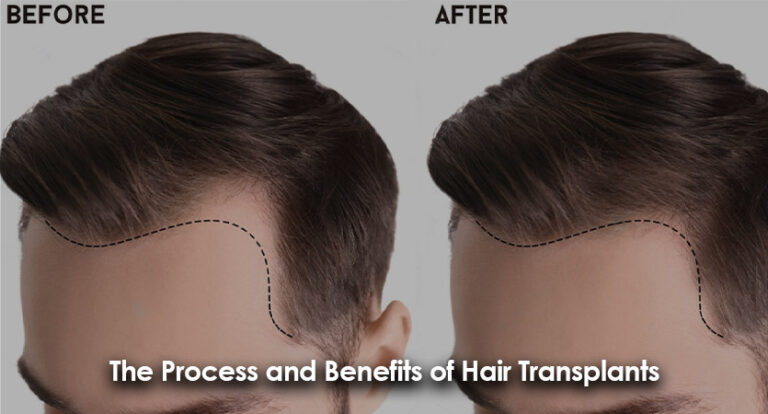 The Process and Benefits of Hair Transplants