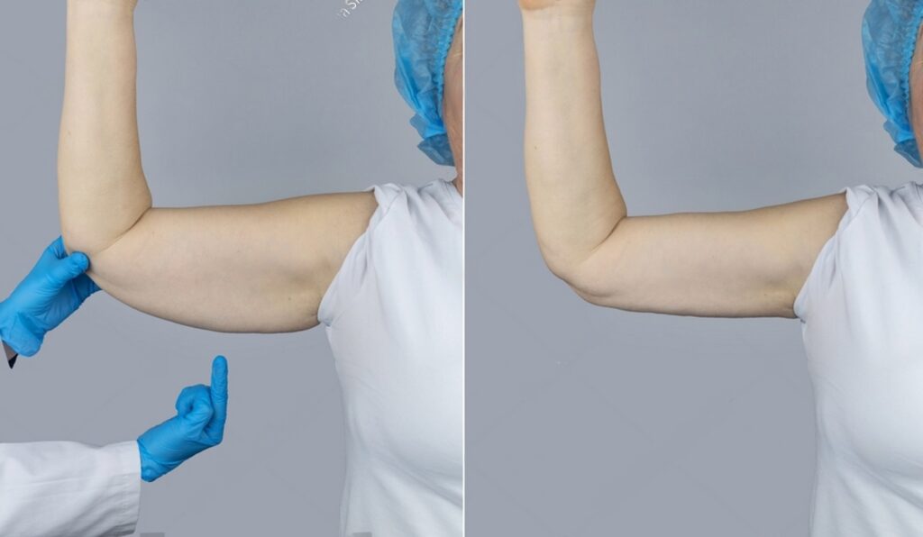 arm lift surgery