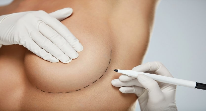 Breast Augmentation