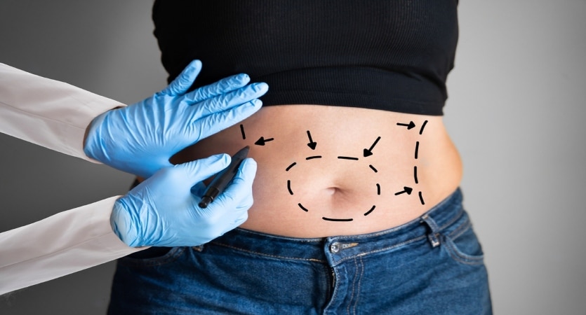 Liposuction