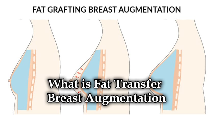 What is Fat Transfer Breast Augmentation