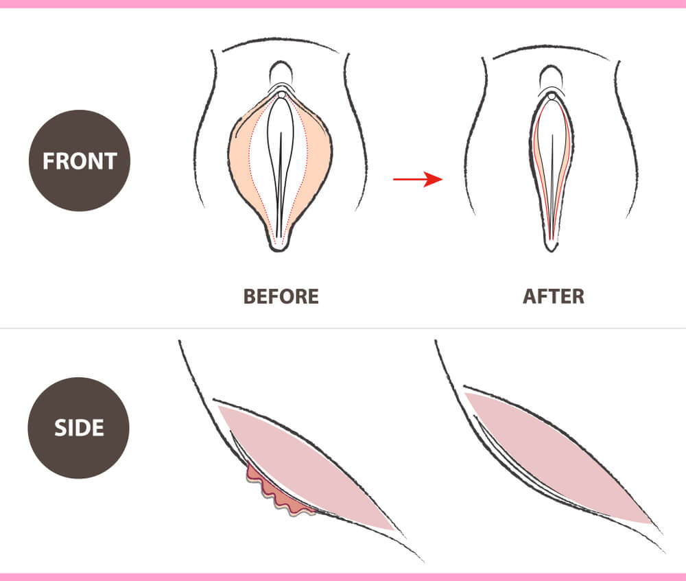 labiaplasty surgery before and after photos