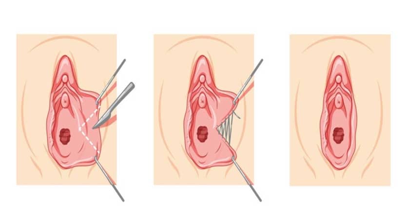 Procedure of labiaplasty