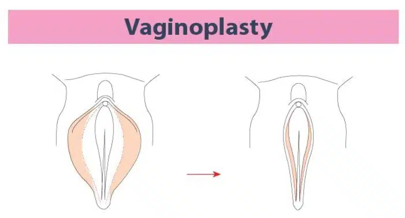 vaginoplasty